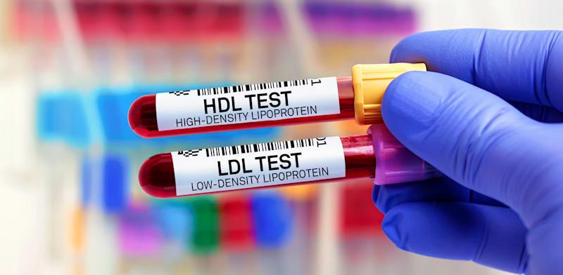 בדיקות כולסטרול / צילום: Shutterstock בדיקות כולסטרול / צילום: Shutterstock